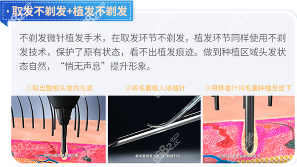 大麦微针不剃发植发技术介绍