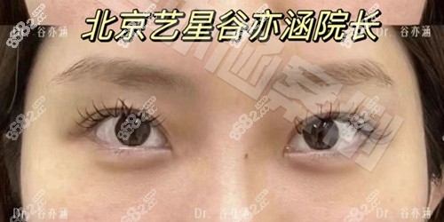 谷亦涵擅長注射眼綜合