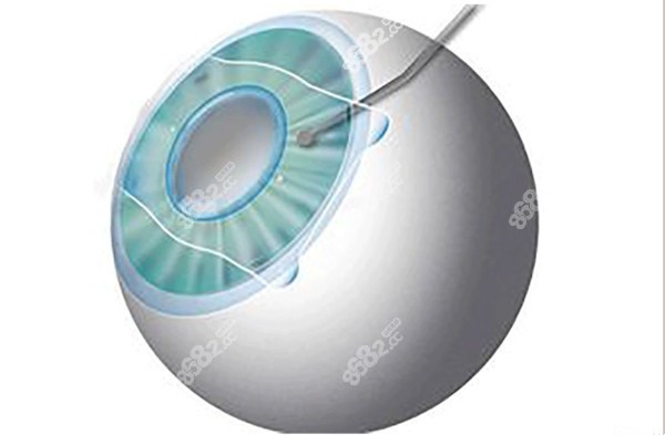 济南做近视激光手术比较好的医院 济南做近视激光手术比较好的医院