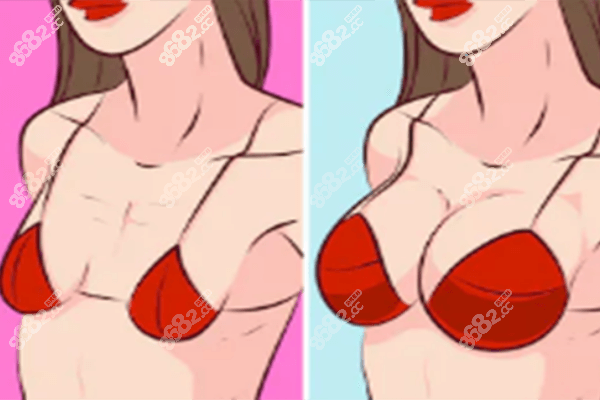 成都高新后美隆胸怎么样