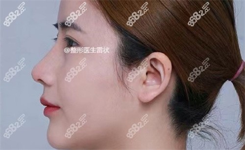 <!--<i data=20240705-sp></i>-->雷狀醫(yī)生肋軟骨隆鼻的真實(shí)口碑