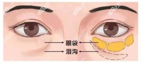 長沙去眼袋醫(yī)院排名