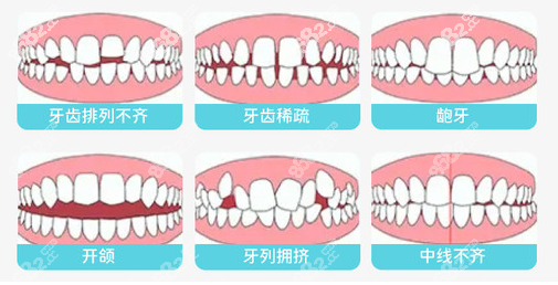 <!--<i data=20240705-sp></i>-->口腔常做的牙齿矫正类型