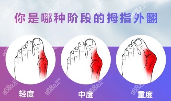 上海虹橋醫(yī)院拇外翻微創(chuàng)矯正在線預(yù)約，張樹偉醫(yī)生技術(shù)好