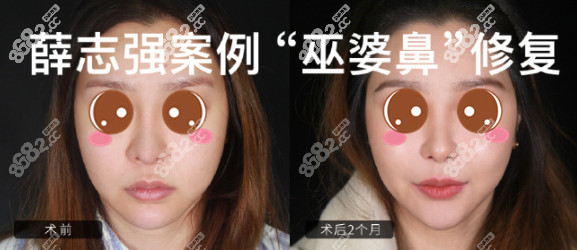 薛志强鼻修复案例对比图