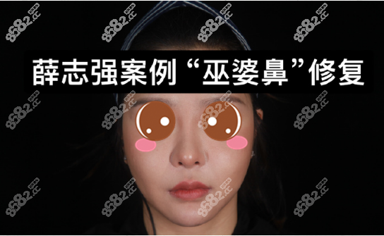北京隆鼻案例