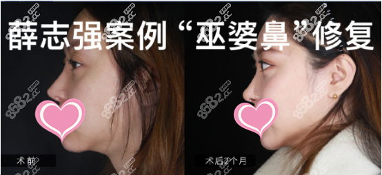 薛之谦鼻修复案例