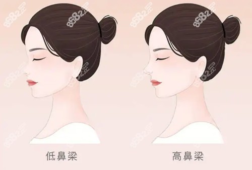隆鼻价格参考  