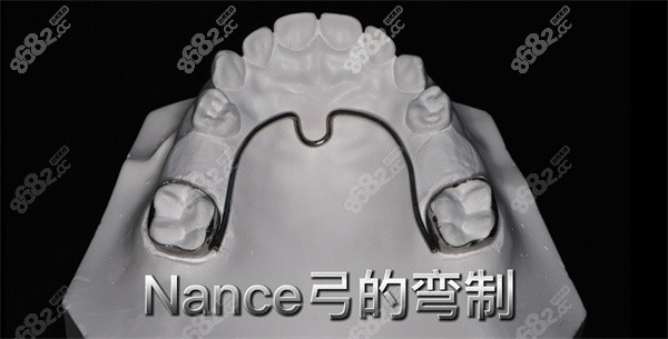 正畸 nance 弓与 tpa 及舌弓主要作用