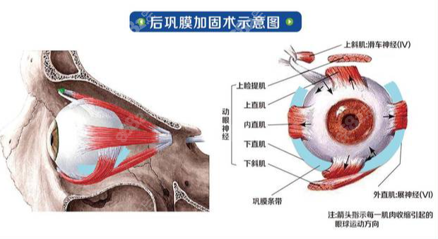 北京协和医院闵寒毅医生做后巩膜加固术技术特色