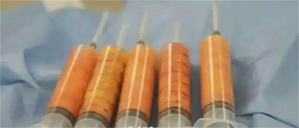 脂肪填充后有硬疙瘩怎么办，填充后长硬块一般多久消失
