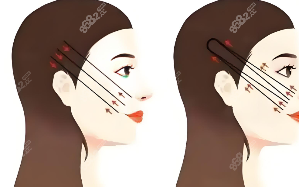 朱自剛醫(yī)生的筋膜提升對比