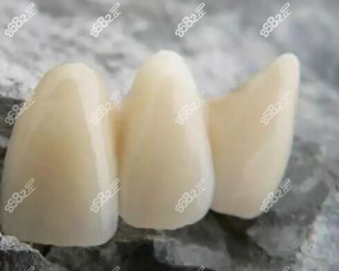 镍铬合金烤瓷牙的优缺点