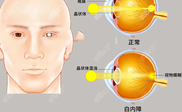 合肥治疗白内障免费政策