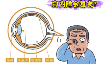 南宁白内障免费政策申请条件