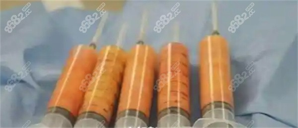 脂肪填充后硬疙瘩从何而来