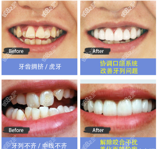 西安圣贝口腔牙齿正畸案例