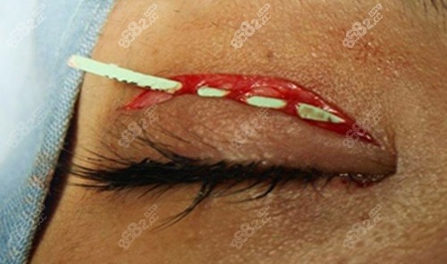 刘志刚眼修复失败例子为0