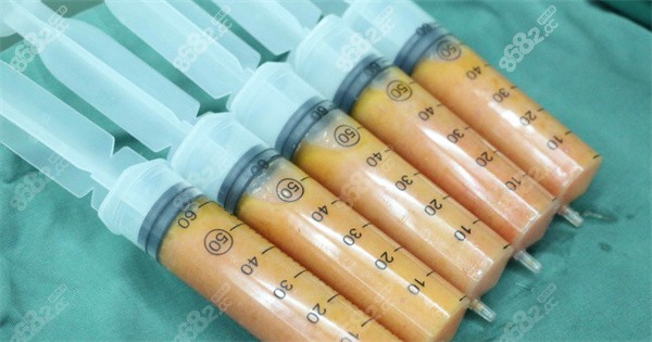 脂肪填充后硬疙瘩从何而来