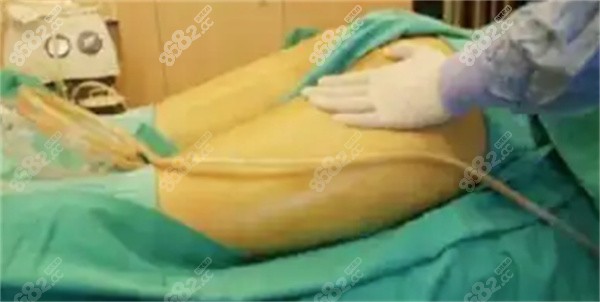 硬疙瘩一般多久会消失