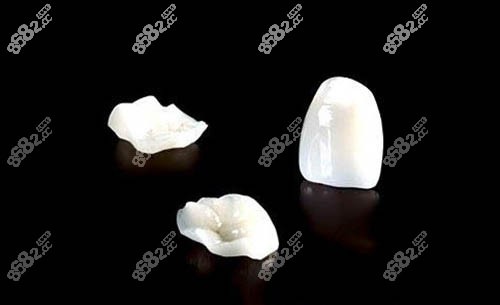 牙齿贴面照片