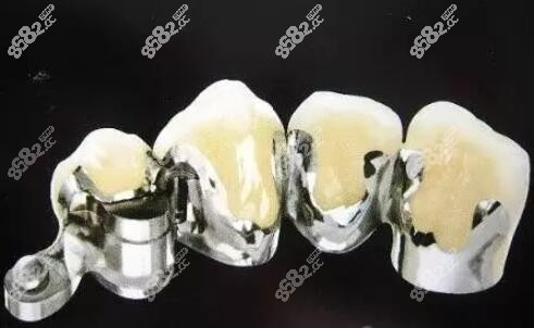 钴铬合金烤瓷牙的优缺点