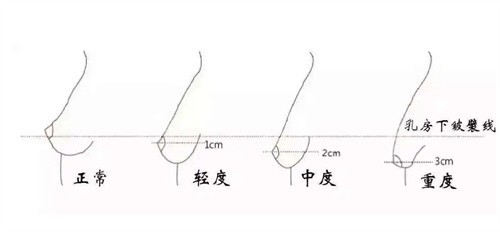 胸部下垂怎么办