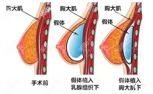 胸部下垂松弛手术