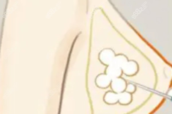 北京脂肪丰胸医生排名