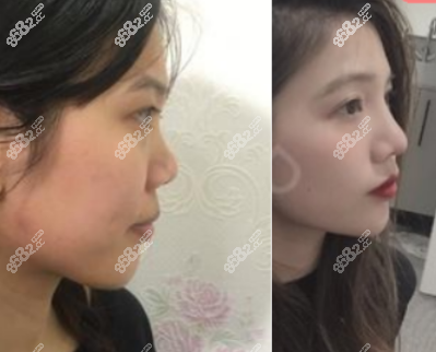 欧阳春医生隆鼻案例2