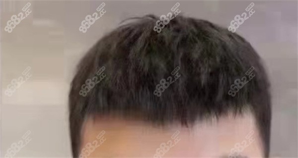 如何促进毛发移植后的生长