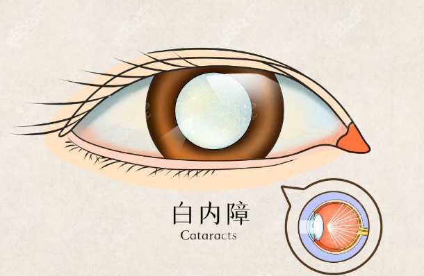 重庆白内障手术哪家医院好