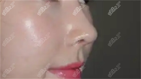 内切法：隐蔽切口，悄然缩窄鼻翼