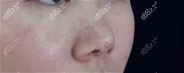 鼻翼整形的三种方法是什么