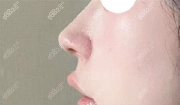 鼻翼整形修复时间多久？