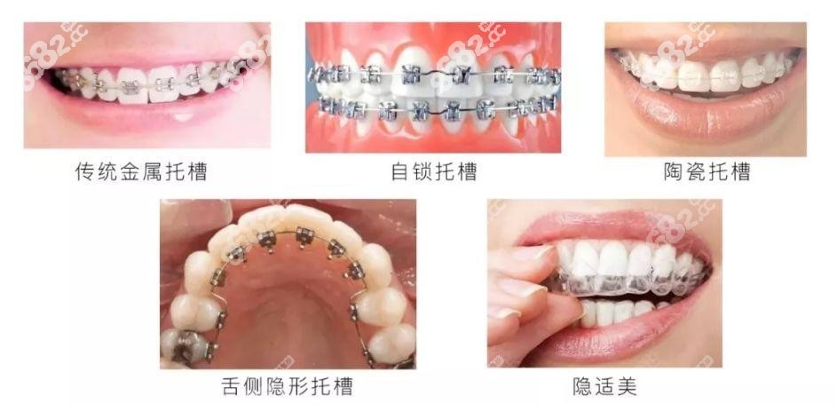 咸宁牙齿矫正的各种矫正器