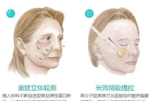 高亞?wèn)|醫(yī)生在拉皮手術(shù)價(jià)格