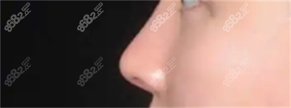 外切法：针对性强，显著改善鼻翼形态