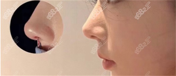 内切法：隐蔽切口，悄然缩窄鼻翼