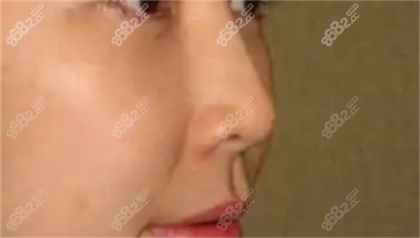 鼻翼整形修复时间多久？