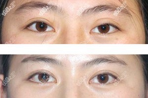 韓國(guó)李喜文雙眼皮寬改窄修復(fù)圖片