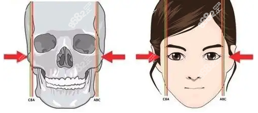 做了颧骨颧弓术手术特别后悔