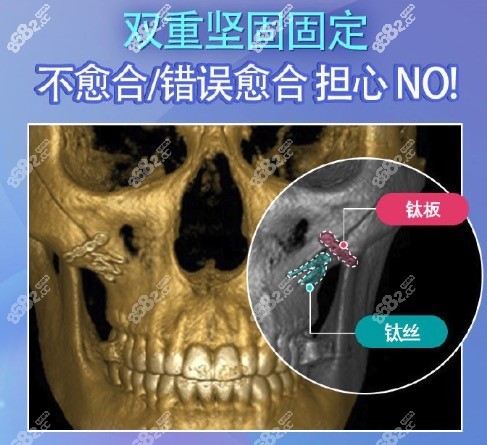 雙重固定術(shù)顴骨手術(shù)是怎么做的？