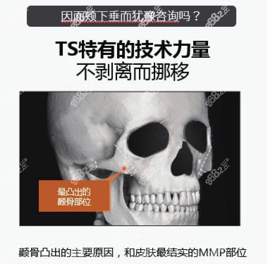 雙重固定術(shù)后能感覺到顴骨晃動嗎?