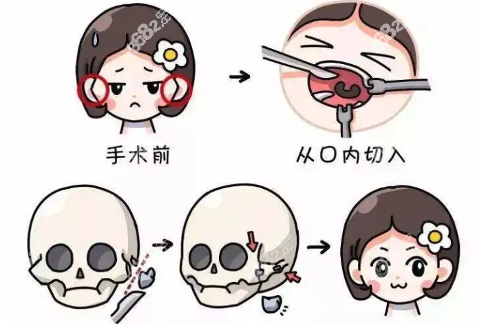颧骨整形手术过程