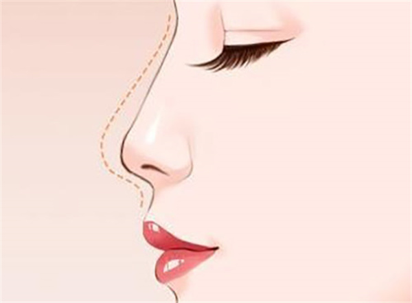 周柯医生做鼻子怎么样？成都大象致颜做鼻修复技术口碑好