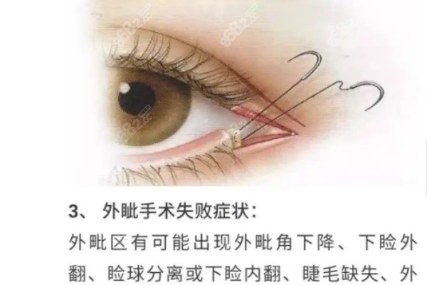 及云澤埋線雙眼皮手術(shù)患者口碑與反饋