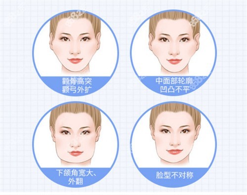 面部輪廓整形適應(yīng)癥圖示
