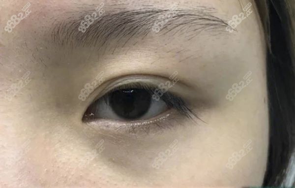 李燕醫(yī)生的雙眼皮手術(shù)口碑好