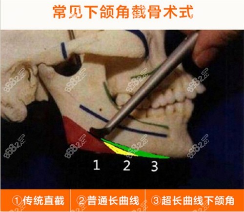 常見(jiàn)的下頜角截骨術(shù)式